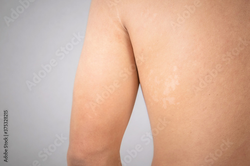 Macro white Pityriasis or Tinea Versicolor on back skin. Skincare concept