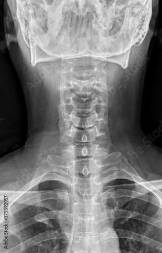 X-ray of cervical spine in anteroposterior position