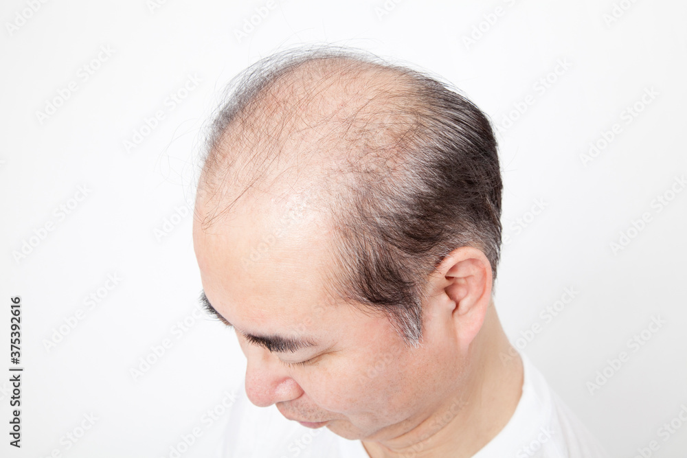 Obraz premium 薄毛の男性