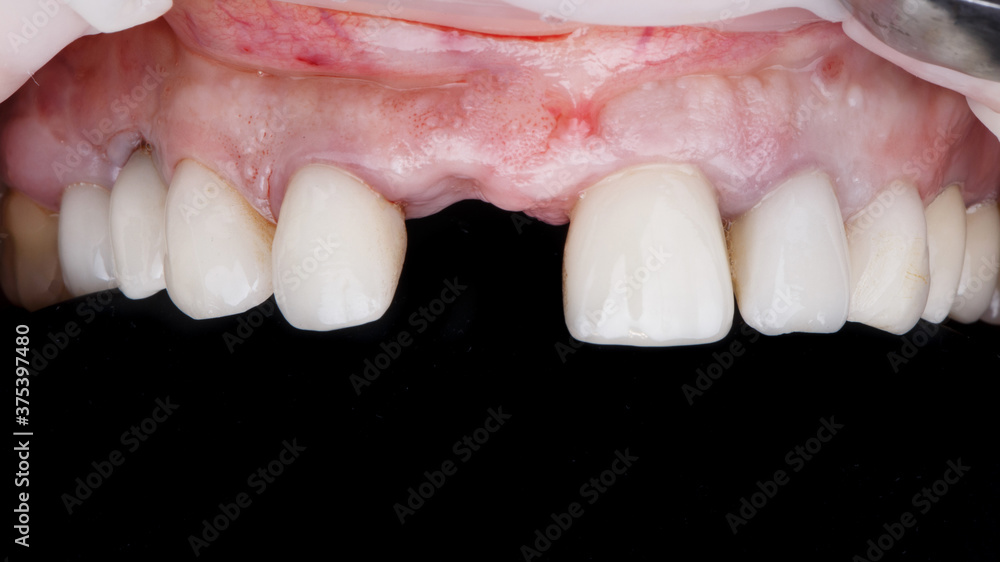 upper celius of a patient without a central tooth before implantation and crown placement