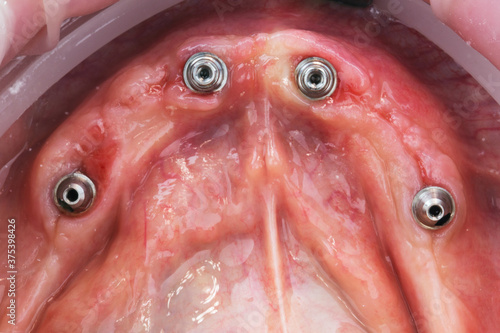 gums after implantation on multi-unit for lower jaw prosthetics