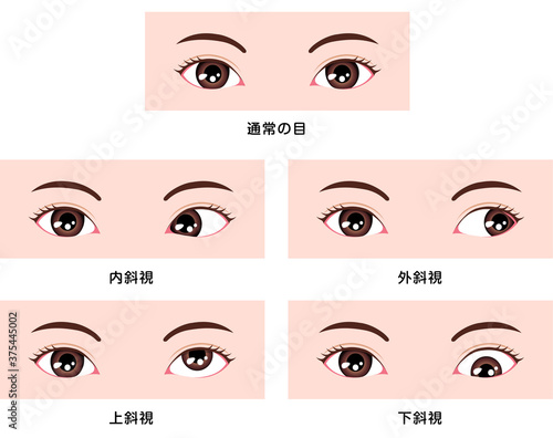 斜視の種類　ベクターイラスト (内斜視・外斜視・上斜視・下斜視）
