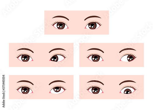 Types of strabismus vector illustration photo