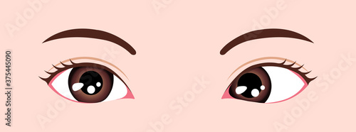 Type of strabismus vector illustration / Esotropia
