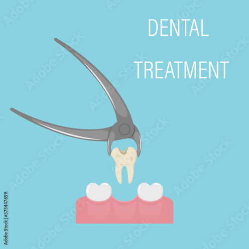 Dental tooth extraction. Exodontia. The tooth in the dental forceps. A white clean tooth is clamped between the forceps. Professional dental instrument. Isolated flat vector illustration.
