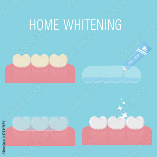 The concept of home teeth whitening From yellow to white. Consecutive stages of bleaching with gel and mouthguard at home.Before and after.Modern comatic procedure. Isolated vector illustration. Flat