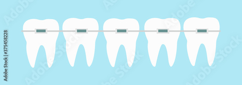 Five teeth with dental braces line vector illustration. Orthodontic treatment