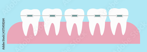 Teeth with orthodontic dental braces correction on the gums