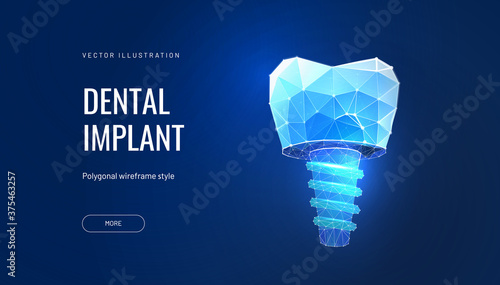 Dental implant, digital technologies in dentistry. Vector illustration of a denture in a polygonal futuristic style. Molar surgery illustrated by a geometric luminous shape