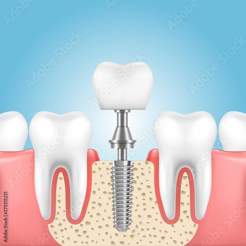 Tooth dental implant, vector dentistry, dentist and denture technologies. Human jaw with health teeth and prosthesis with implant crown, screw and abutment, dental medicine themes