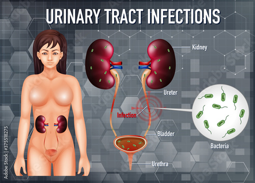 Informative illustration of urinary tract infections