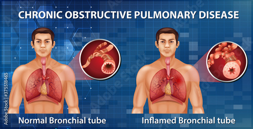Chronic obstructive pulmonary disease