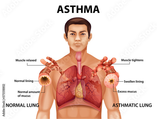 Comparison of healthy lung and Asthmatic lung