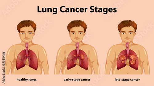 Informative illustration of lung cancer stages