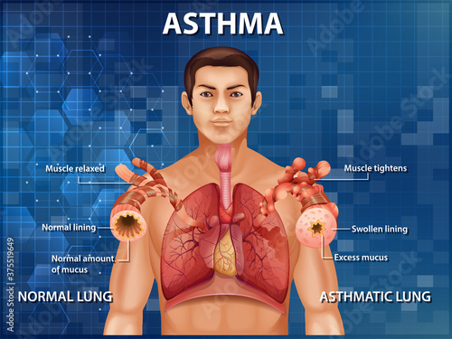 Human anatomy Asthma diagram