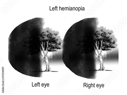 patterns of visual field defects are sign and symtomp of loss of vision which are derived from brain lesion and optic nerve lesion.