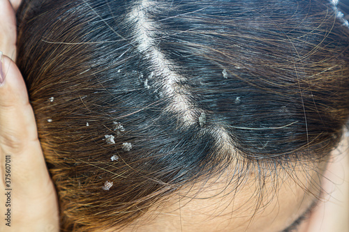 closeup hair with dandruff scalp, Seborrheic Dermatitis  photo
