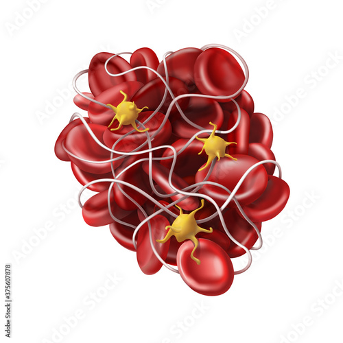 Medicine. A blood clot or thrombus - coagulation. 3d vector illustration