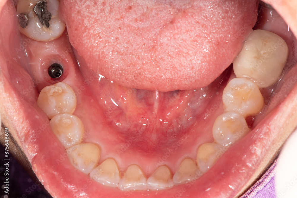 Gingival cuff after remove healing abutment from dental implant Stock