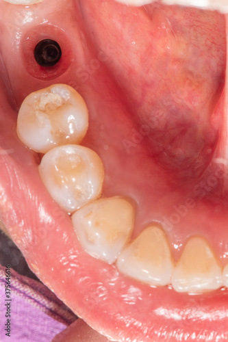 Gingival cuff after remove healing abutment from dental implant