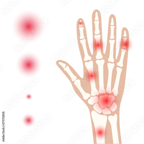 Arthrits x ray