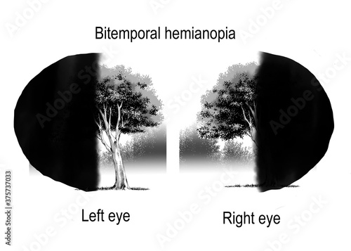 patterns of visual field defects are sign and symtomp of loss of vision which are derived from brain lesion and optic nerve lesion.