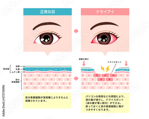 健康な目とドライアイの目の比較イラスト
