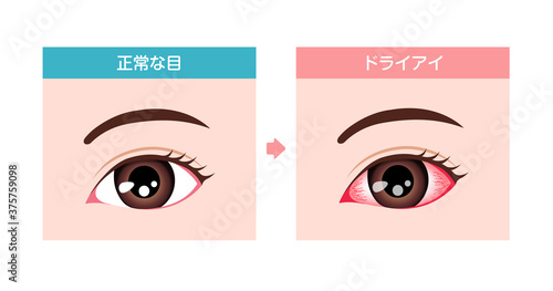 健康な目とドライアイの目の比較イラスト

