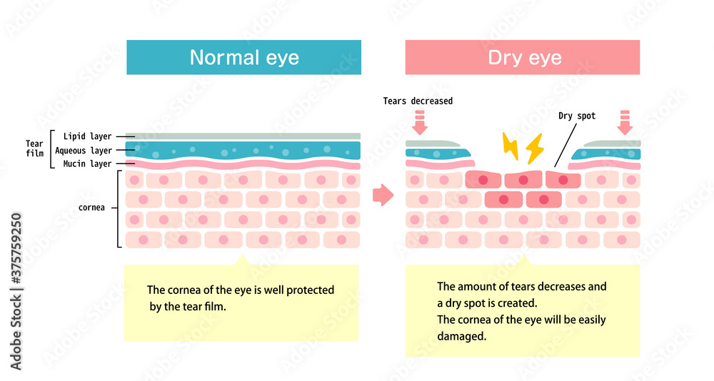 Comparison illustration between normal and dry eye. Cross section of eye surface.