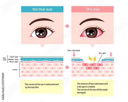 Comparison illustration between normal and dry eye. Cross section of eye surface.