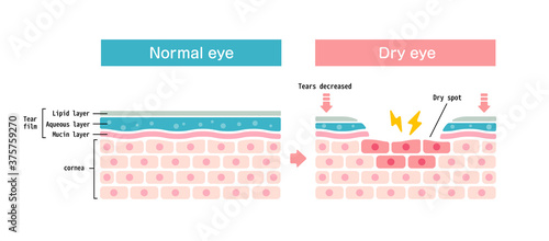 Comparison illustration between normal and dry eye. Cross section of eye surface.