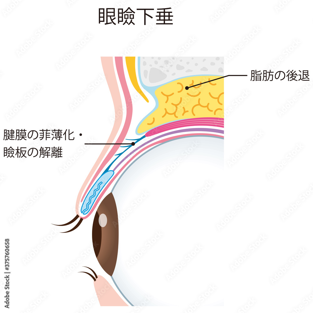 眼瞼下垂 瞼の構造 眼球 断面 Stock Illustration | Adobe Stock