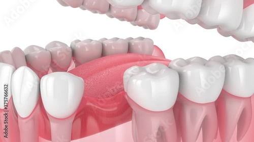 Teeth sliding towards the area of missing tooth. Consequences of tooth loss. 