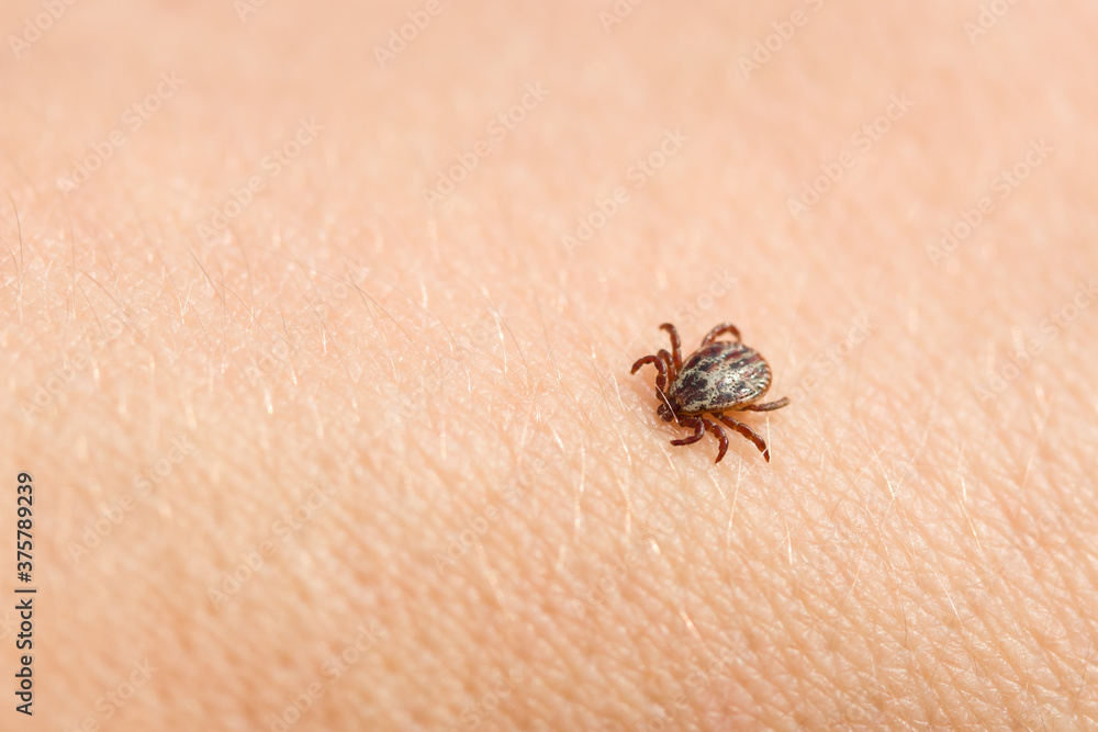 Obraz premium Blood-sucking pest ixodid tick on the human body close-up