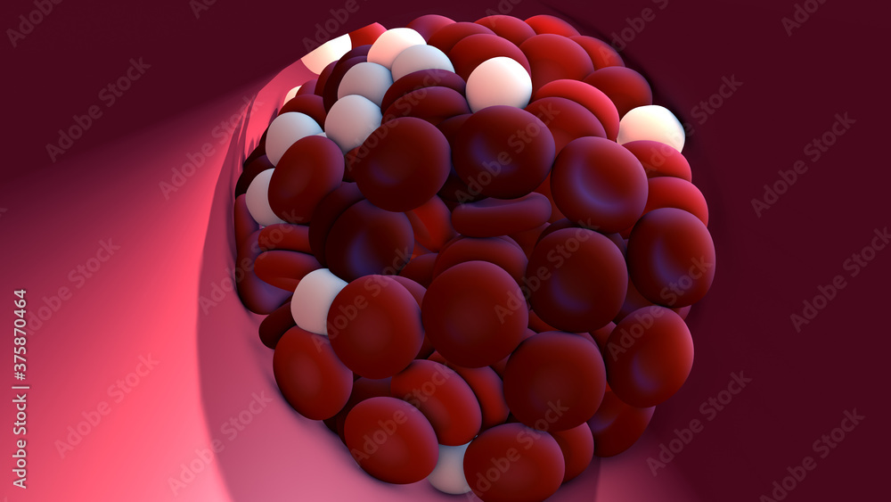 Formation of blood clots in the blood system. Clot in blood vessels