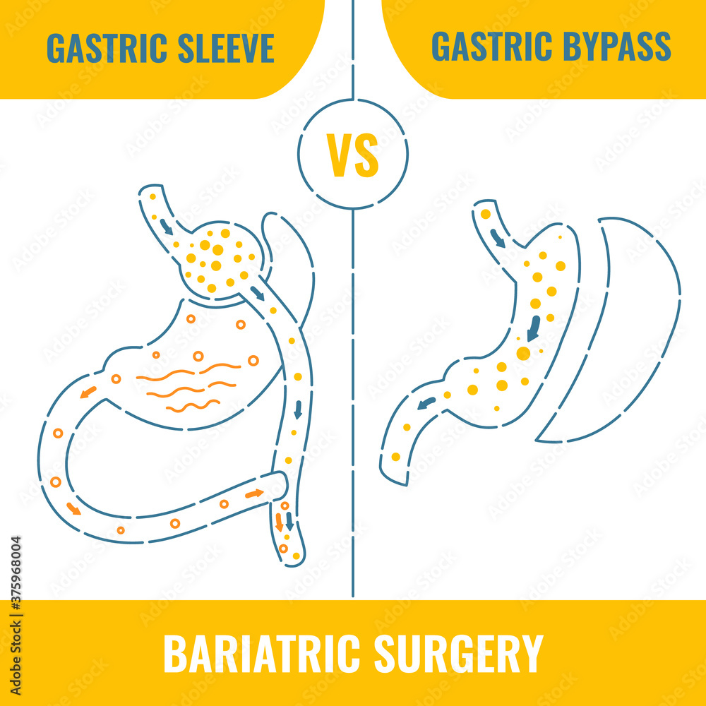 Vecteur Stock Gastric sleeve vs gastric bypass. Bariatric surgery
