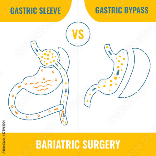 Gastric sleeve vs gastric bypass. Bariatric surgery weight loss procedures comparison. Stomach reduction anatomical diagram infographics. Health care medical concept. Line vector illustration.