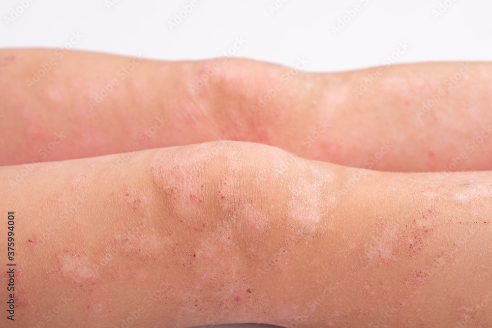Fototapeta premium manifestation of dermatitis on the child body, rash on the legs close-up, redness on the skin, allergic reaction