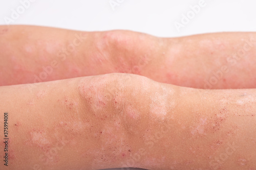 manifestation of dermatitis on the child body, rash on the legs close-up, redness on the skin, allergic reaction