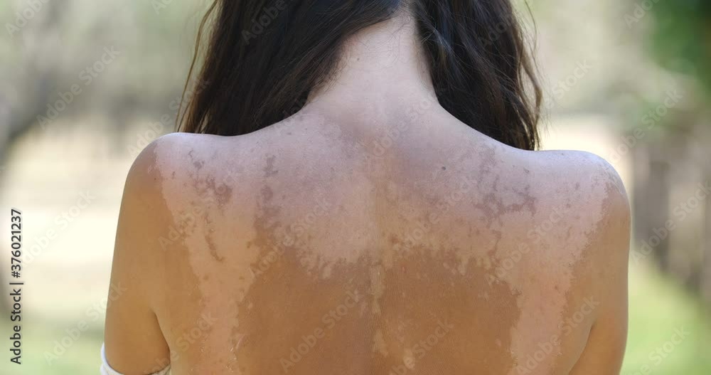 Close up of a woman's back with uneven pigmentation. Skin problems ...
