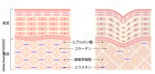 健康な肌としわ　断面図
