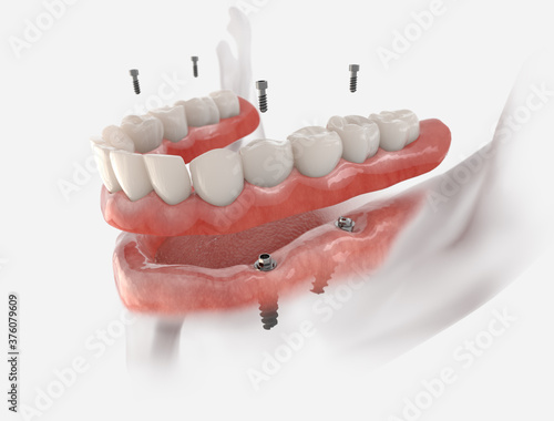 Mandibular fixed restoration with 4 implants, posterior are tilted.  3d illustration of implant on white background. Dental prosthetic innovation. photo