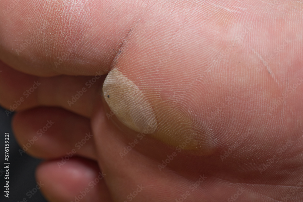 big white callus on a man's foot big white callus on a man's foot