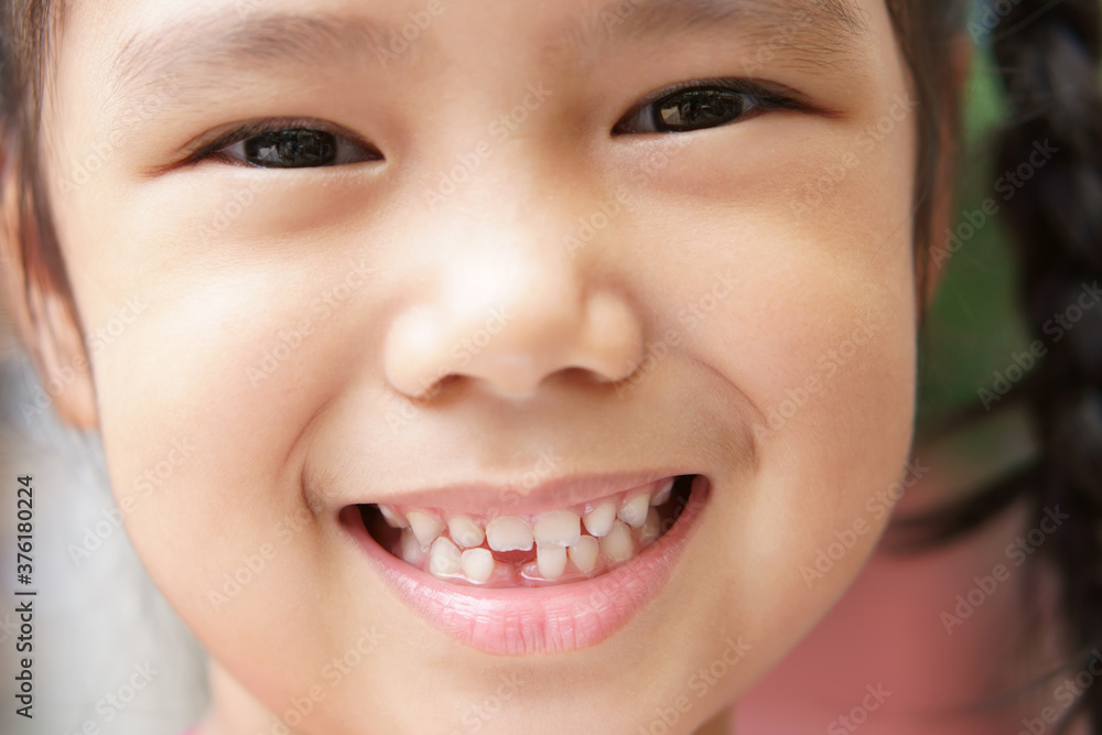 Asian child cute or kid girl smile white teeth and first broken tooth or drop from baby or milk tooth on 6 years old for dental background by closeup face and teeth focus Asian child cute or kid girl smile white teeth and first broken tooth or drop from baby or milk tooth on 6 years old for dental background by closeup face and teeth focus