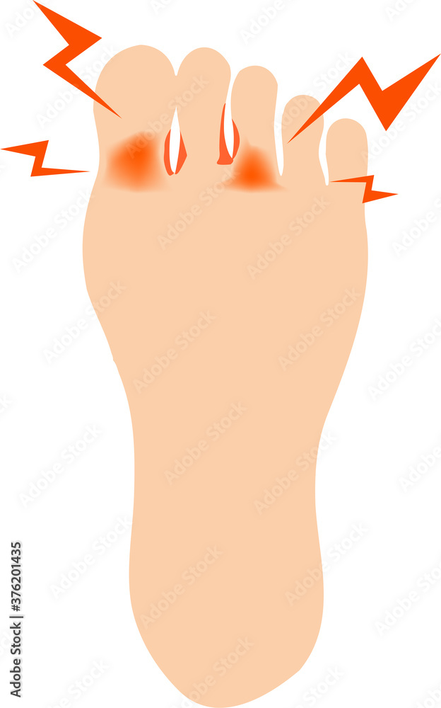 足の指の間が水虫で痒い足のイラスト Stock Vector Adobe Stock 足の指の間が水虫で痒い足のイラスト Stock Vector Adobe Stock