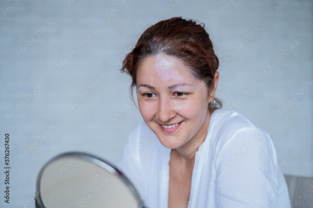 Portrait of a Caucasian woman with vitiligo. A girl with a white pigment spot on her forehead looks in the mirror. An autoimmune disease affecting the skin. Portrait of a Caucasian woman with vitiligo. A girl with a white pigment spot on her forehead looks in the mirror. An autoimmune disease affecting the skin.