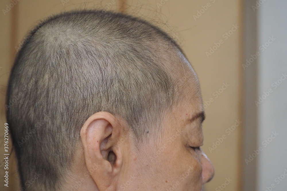 Obraz premium Side view of an old Asian woman with hair growth after finishing her chemotherapy course