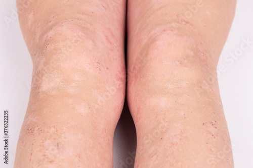 rash on children legs close-up  redness of the skin  allergic reaction
