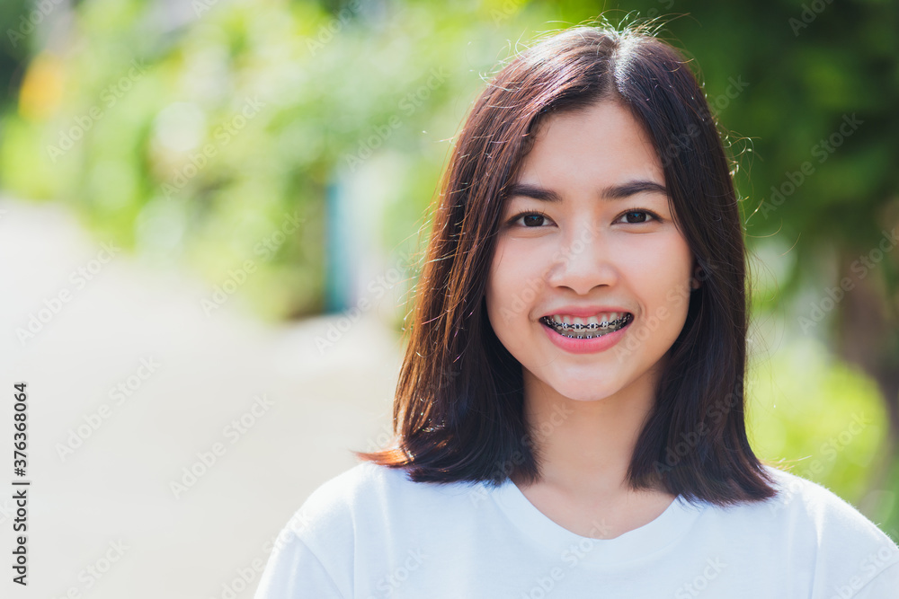 Portrait of Asian teen beautiful young woman smile have dental braces on teeth laughing outdoor, Medicine and dentistry concept Portrait of Asian teen beautiful young woman smile have dental braces on teeth laughing outdoor, Medicine and dentistry concept