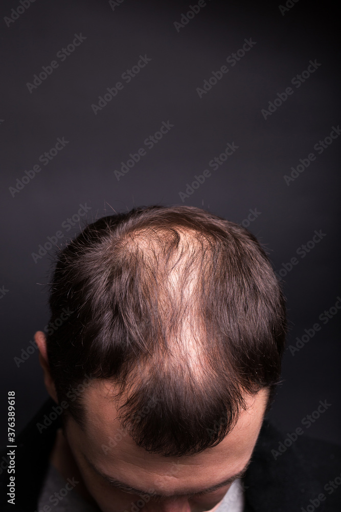 Fototapeta premium Male head close-up with baldness. Studio black background.